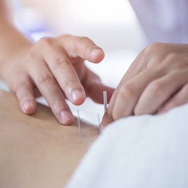 Close-up of acupuncture needles being used on a patient's back